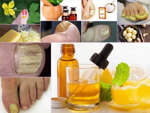 remedii populare pentru tratarea ciupercilor de pe unghiile picioarelor