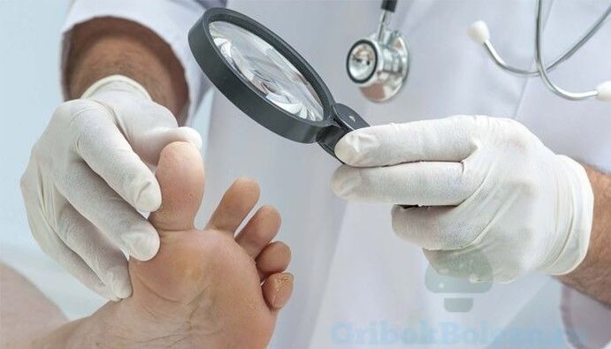 diagnosticul ciupercii piciorului de către un medic