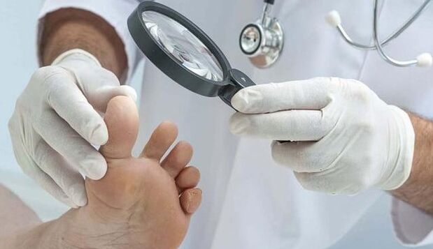 Diagnosticul ciupercii