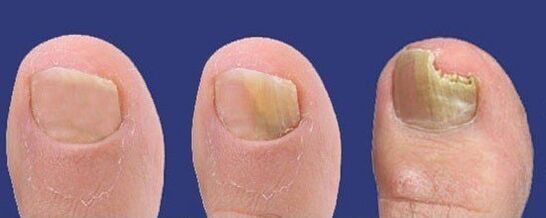 Dezvoltarea ciupercii unghiilor de la picioare