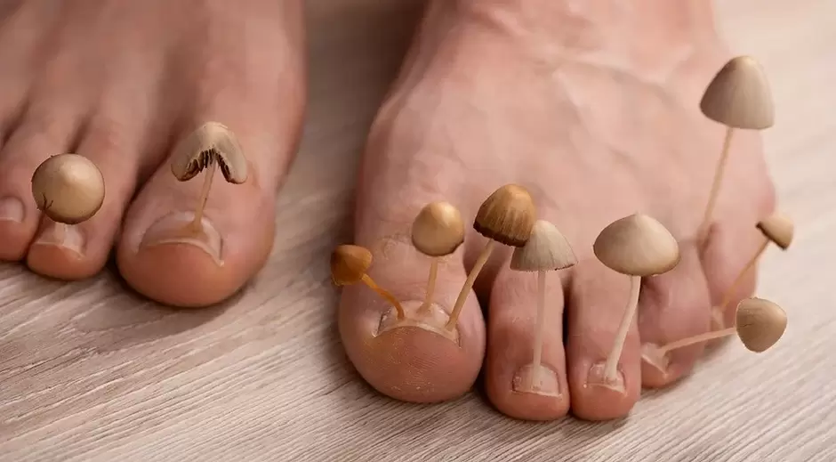 Infecție fungică care afectează unghiile de la picioare
