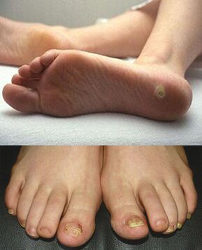 Manifestări de micoză pe pielea și unghiile picioarelor