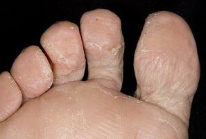 Pielea picioarelor cu o infecție fungică