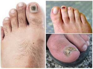 Semne ale unei infecții fungice ale unghiilor de la picioare