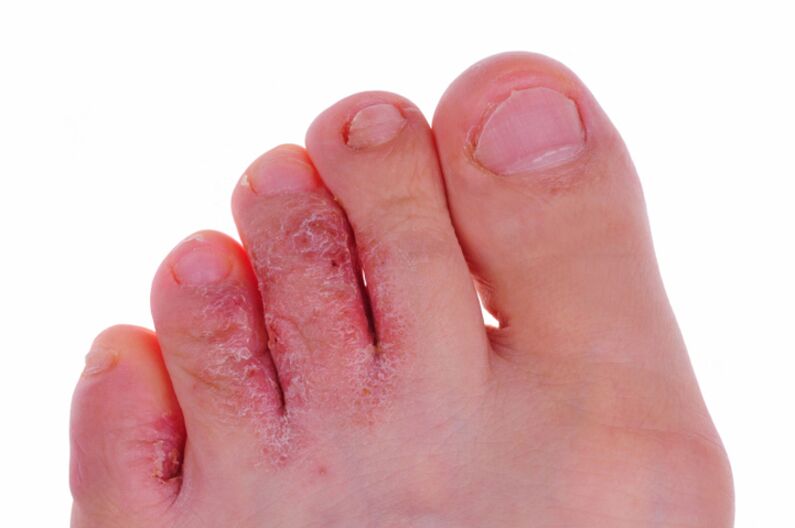 Simptome de rubrofitoză - crăpături și scuame pe pielea picioarelor