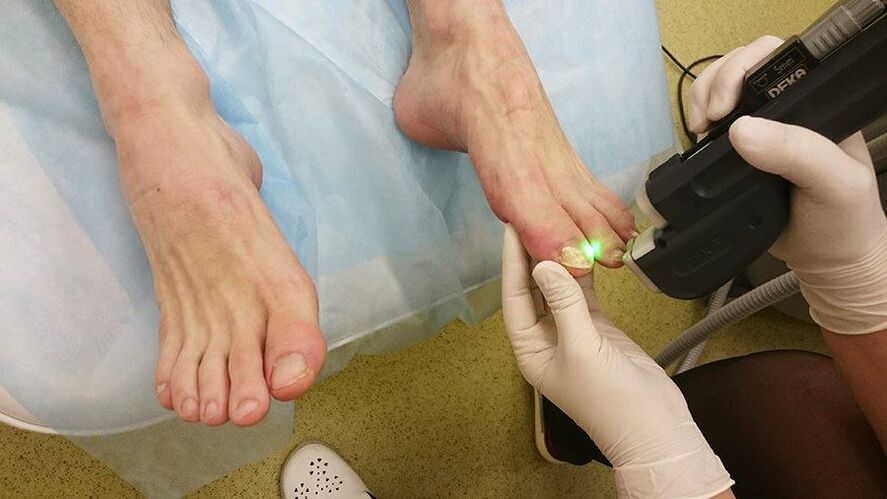 Tratament cu laser pentru ciuperca unghiilor de la picioare