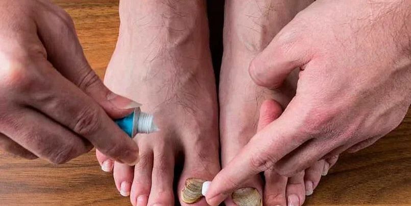 cauzele ciupercii între degetele de la picioare