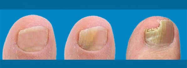 Dezvoltarea onicomicozei - ciuperca unghiilor de la picioare