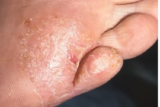 Manifestări ale unei infecții fungice pe pielea piciorului