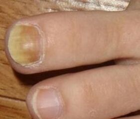 Simptome ale etapei inițiale a ciupercii de unghii